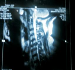 Cervical Cord Compression 11