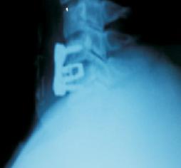 Cervical Cord Compression 12