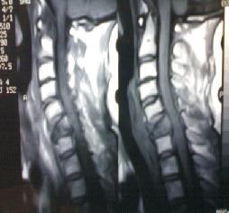 Cervical Vertebral Fracture 7