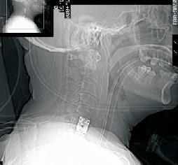 Cervical Vertebral Fracture 8