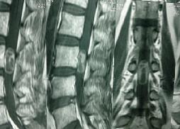 Intradural Neurofibroma 15