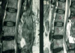 Intradural Neurofibroma 16