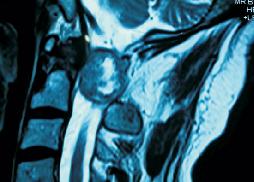 Large CV Junction Intradural Neurofibroma 27