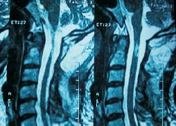 Large CV Junction Intradural Neurofibroma 28