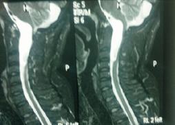 Large CV Junction Intradural Tumor 17