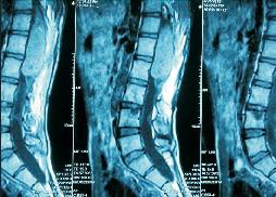 Large Conus Ependymoma 29