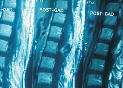 Large Conus Ependymoma 30