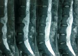 Large Intradural Dermoid 19