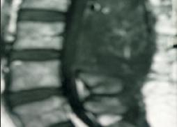 Large Intradural Dermoid 20