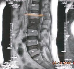 Lumbar Spinal Metastasis 13