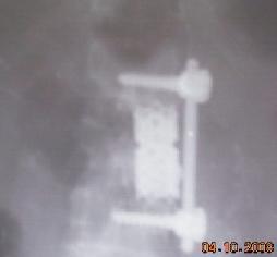 Lumbar Spinal Metastasis 14