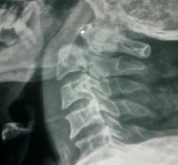 Odantoid Fracture 1