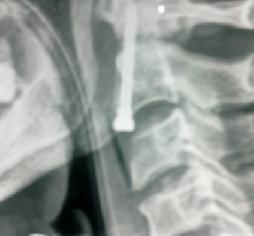 Odantoid Fracture 2