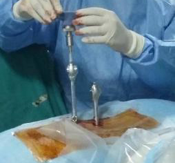 Percutaneous Spinal Fixation 23