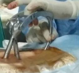 Percutaneous Spinal Fixation 24