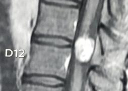 Spine Tumor 22