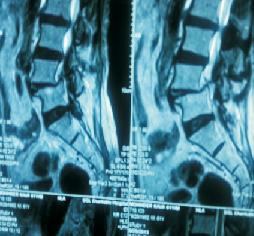 Spondy-Lolisthesis 25