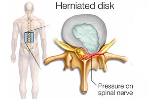 Herniated Disk