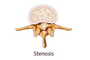 Spinal Stenosis