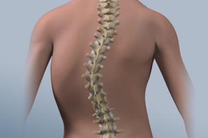 Scoliosis