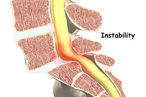 Spinal Instability
