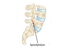 Spondylolysis