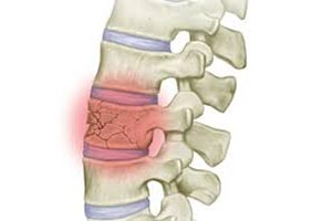 Fractured Vertebra